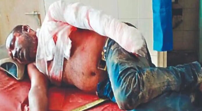 जमीन विवाद में युवक को पेट्रोल छिड़क जिंदा जलाने का प्रयास, बचाने में 3 भाई झुलसे burn-man
