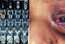 Covid-19 Effect: ब्लैक फंगस का इलाज करनेवाली एंटी-फंगल दवा के अभाव ने बढ़ाई चिंता mucoramycosis_disease