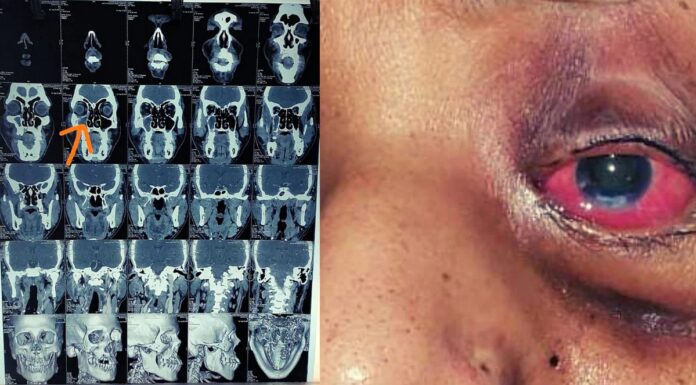 mucoramycosis_disease