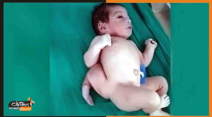तीन हाथ और तीन पैर वाला अनोखा बच्चा, दर्शन को उमड़ी भीड़ 3-pai-3-hath-wala-bachcha