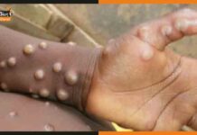 मंकीपॉक्स का बढ़ा प्रकोप, अमेरिका में पहली बार बच्चों में मिला मंकीपॉक्स monkeypox