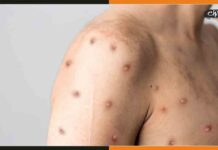 बिहार में बढ़ रहा मंकीपॉक्स का खतरा, पटना के बाद राजगीर में मिला मरीज Monkey-Pox