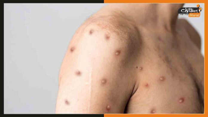 Monkey-Pox