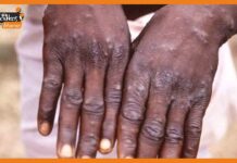 मंकीपॉक्स के बढ़ते मामलों के बीच, स्वास्थ्य मंत्रालय ने जारी किए दिशा-निर्देश monkeypox