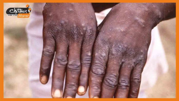 monkeypox