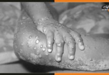 दिल्ली में मिला मंकीपॉक्स का 5वां केस, संक्रमितों का आंकड़ा 10 पहुंचा MonkeyPox
