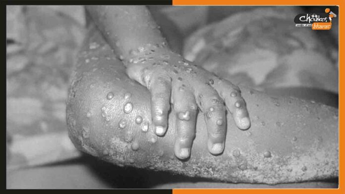 MonkeyPox